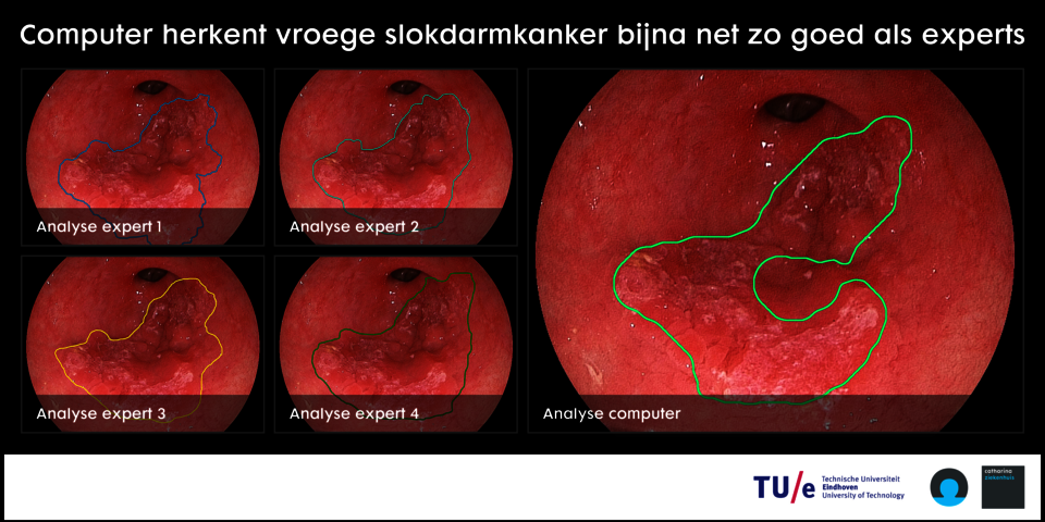 TU/e-software helpt opsporing slokdarmkanker fors vooruit